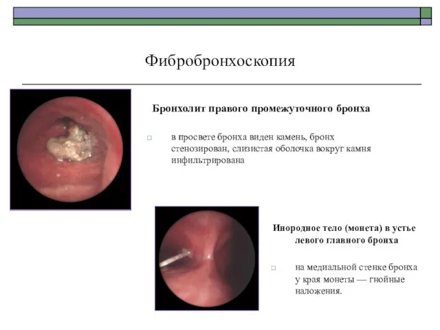 Бронхолит правого промежуточного бронха в просвете бронха виден камень, бронх стенозирован,