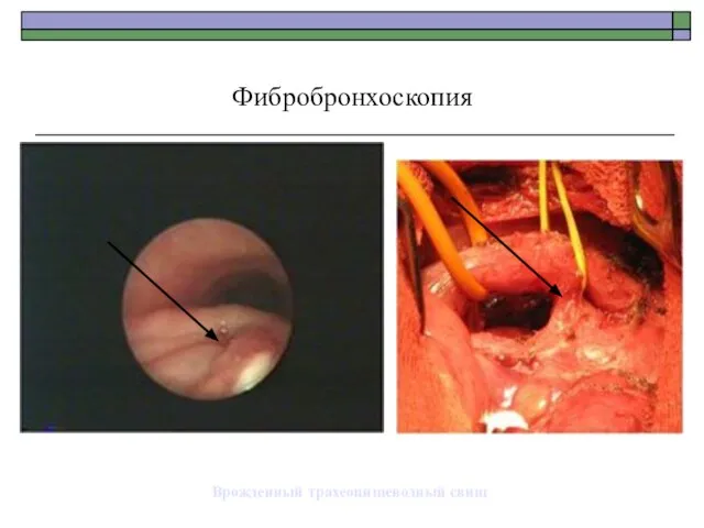 Врожденный трахеопищеводный свищ Фибробронхоскопия