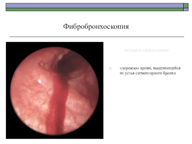 Легочное кровотечение «дорожка» крови, выделяющейся из устья сегментарного бронха Фибробронхоскопия