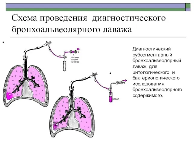 Схема проведения диагностического бронхоальвеолярного лаважа Диагностический субсегментарный бронхоальвеолярный лаваж для цитологического и бактериологического исследования бронхоальвеолярного содержимого.