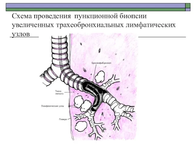 Схема проведения пункционной биопсии увеличенных трахеобронхиальных лимфатических узлов