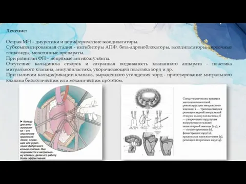 Лечение: Острая МН – диуретики и периферические вазодилататоры. Субкомпенсированная стадия -