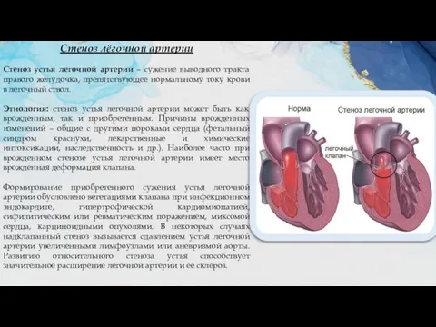 Стеноз лёгочной артерии Стеноз устья легочной артерии – сужение выводного тракта