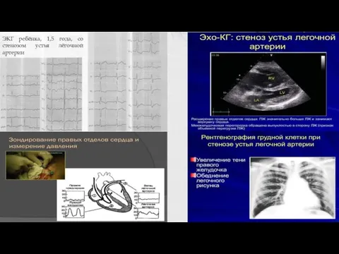 ЭКГ ребёнка, 1,5 года, со стенозом устья лёгочной артерии
