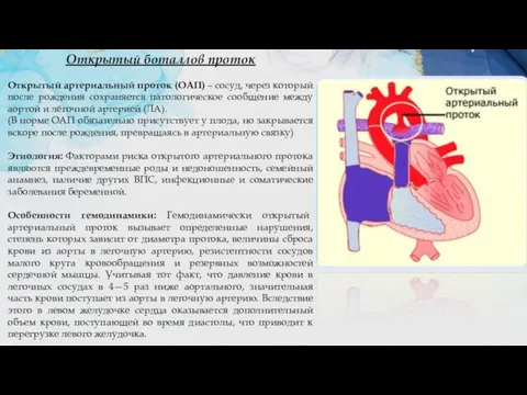 Открытый боталлов проток Открытый артериальный проток (ОАП) – сосуд, через который