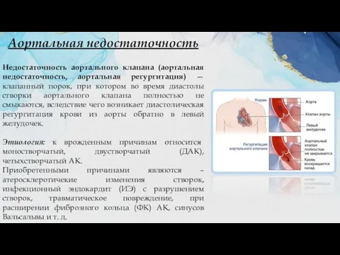 Аортальная недостаточность Недостаточность аортального клапана (аортальная недостаточность, аортальная регургитация) — клапанный