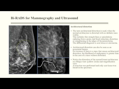 Bi-RADS for Mammography and Ultrasound Architectural distortion The term architectural distortion