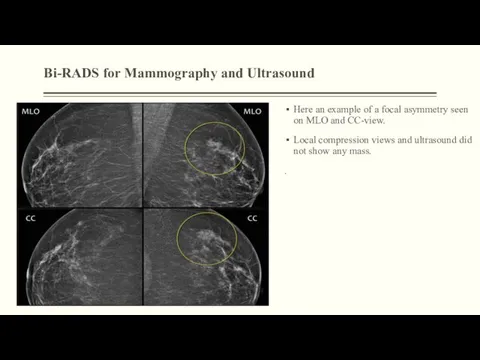Bi-RADS for Mammography and Ultrasound Here an example of a focal