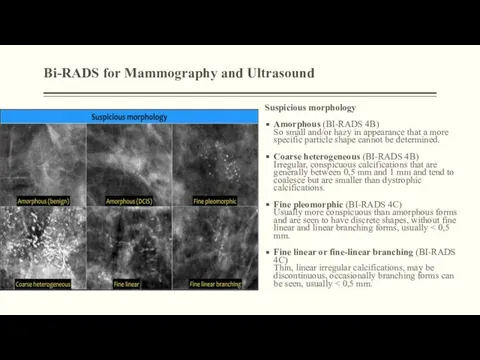 Bi-RADS for Mammography and Ultrasound Suspicious morphology Amorphous (BI-RADS 4B) So