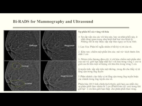 Bi-RADS for Mammography and Ultrasound Sự phân bố các vùng vôi