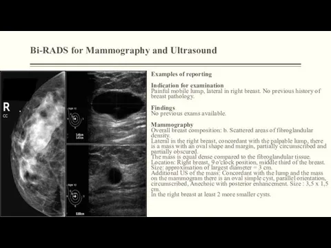 Bi-RADS for Mammography and Ultrasound Examples of reporting Indication for examination