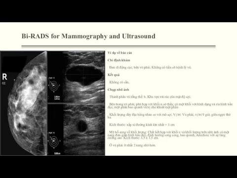 Bi-RADS for Mammography and Ultrasound Ví dụ về báo cáo Chỉ