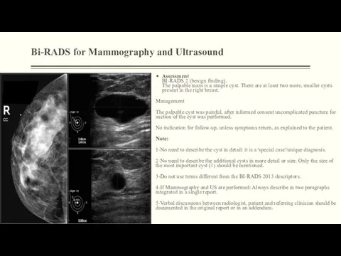 Bi-RADS for Mammography and Ultrasound Assessment BI-RADS 2 (benign finding). The