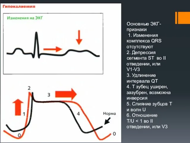 Основные ЭКГ- признаки 1. Изменения комплекса QRS отсутствуют 2. Депрессия сегмента