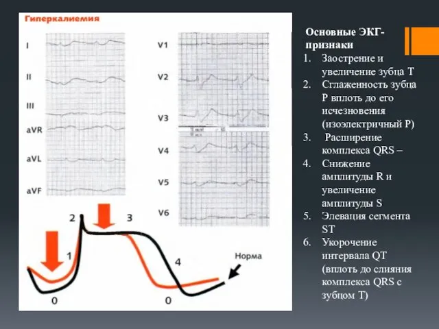 Основные ЭКГ- признаки Заострение и увеличение зубца Т Сглаженность зубца Р