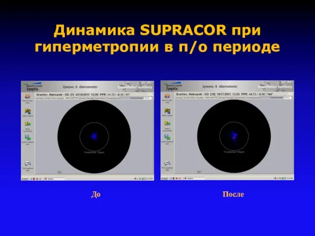 Динамика SUPRACOR при гиперметропии в п/о периоде До После