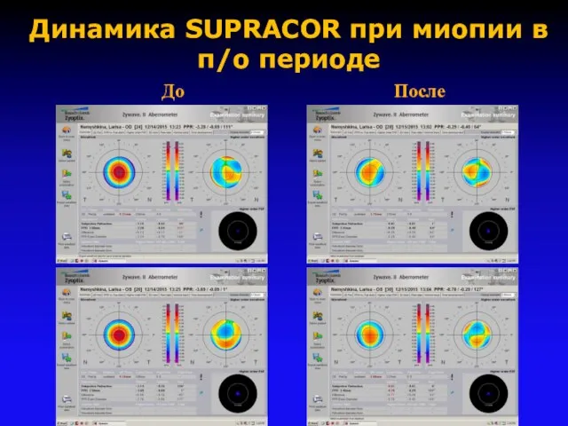 Динамика SUPRACOR при миопии в п/о периоде До После