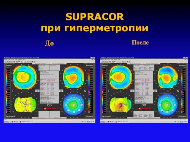 SUPRACOR при гиперметропии После До