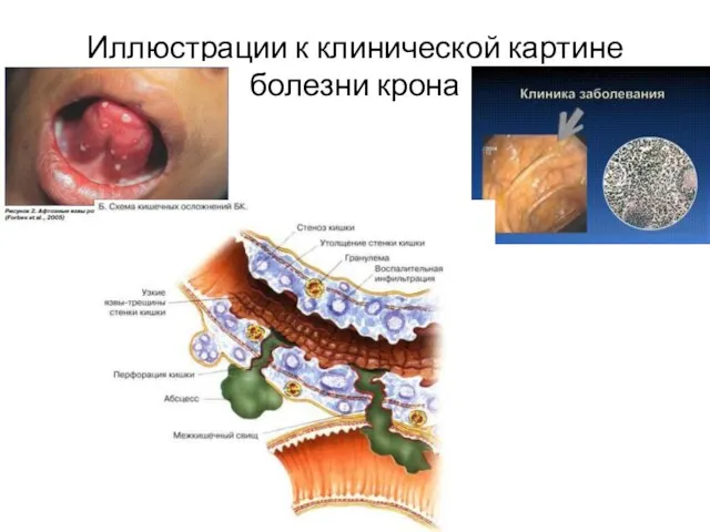 Иллюстрации к клинической картине болезни крона