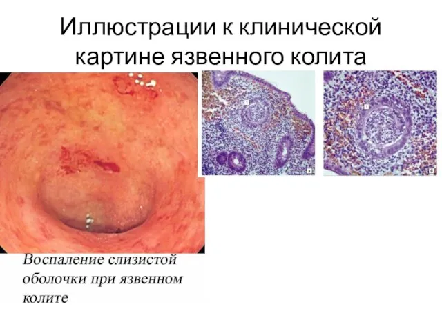 Иллюстрации к клинической картине язвенного колита