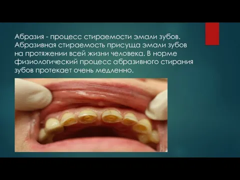 Абразия - процесс стираемости эмали зубов. Абразивная стираемость присуща эмали зубов