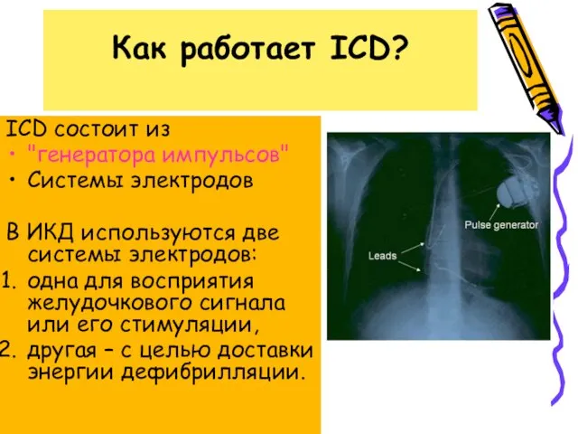 Как работает ICD? ICD состоит из "генератора импульсов" Системы электродов В