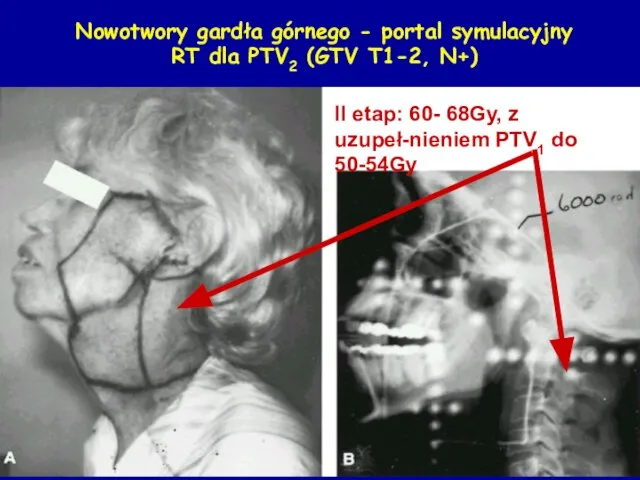 Nowotwory gardła górnego - portal symulacyjny RT dla PTV2 (GTV T1-2,