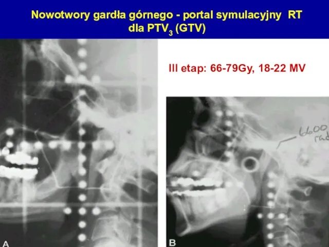 Nowotwory gardła górnego - portal symulacyjny RT dla PTV3 (GTV) III etap: 66-79Gy, 18-22 MV