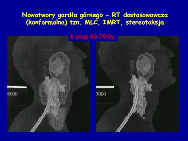 Nowotwory gardła górnego - RT dostosowawcza (konformalna) tzn. MLC, IMRT, stereotaksja II etap 60-70Gy