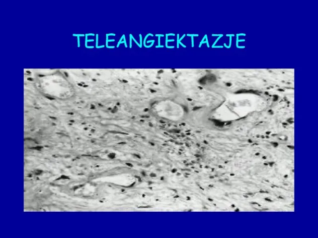 TELEANGIEKTAZJE