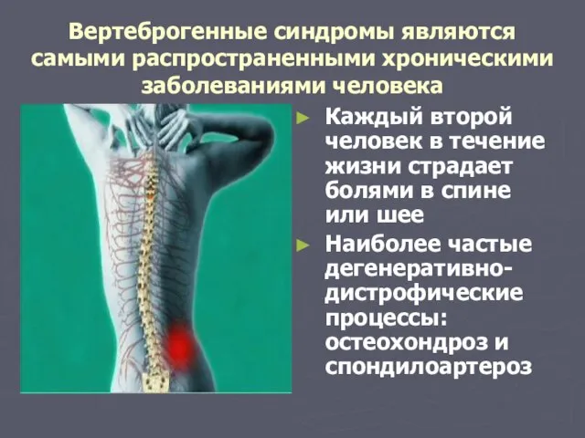 Вертеброгенные синдромы являются самыми распространенными хроническими заболеваниями человека Каждый второй человек