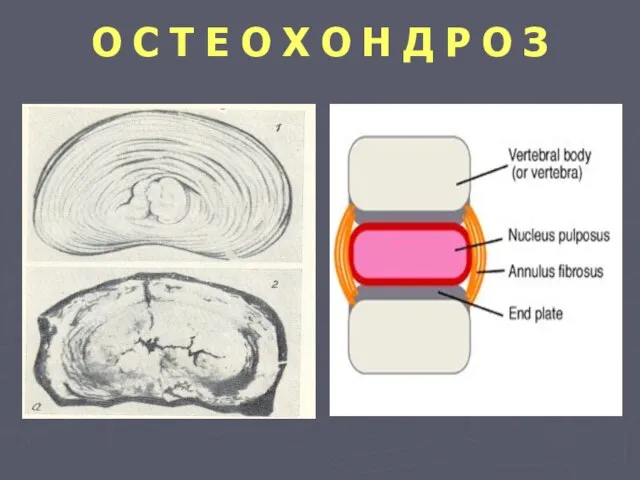 О С Т Е О Х О Н Д Р О З