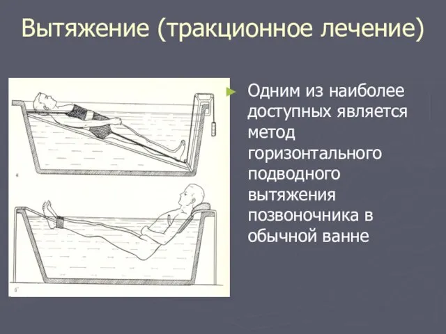 Вытяжение (тракционное лечение) Одним из наиболее доступных является метод горизонтального подводного вытяжения позвоночника в обычной ванне