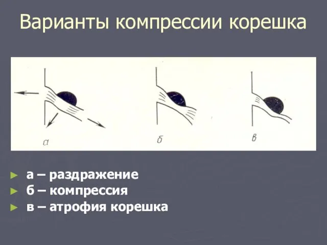 Варианты компрессии корешка а – раздражение б – компрессия в – атрофия корешка