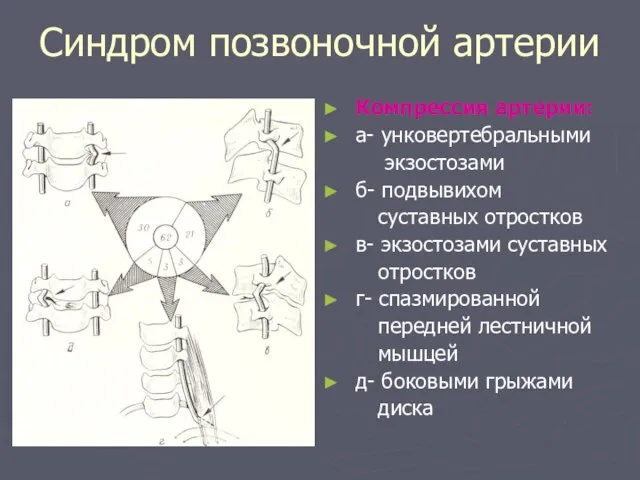 Синдром позвоночной артерии Компрессия артерии: а- унковертебральными экзостозами б- подвывихом суставных