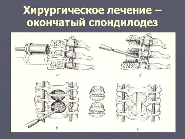 Хирургическое лечение – окончатый спондилодез