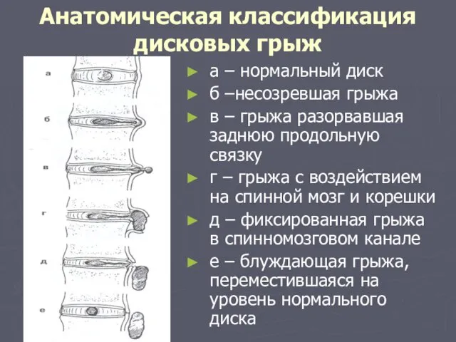 Анатомическая классификация дисковых грыж а – нормальный диск б –несозревшая грыжа