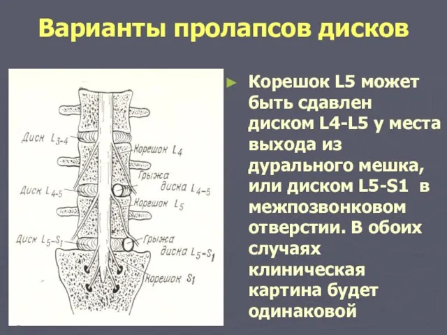 Варианты пролапсов дисков Корешок L5 может быть сдавлен диском L4-L5 у