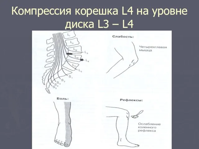 Компрессия корешка L4 на уровне диска L3 – L4