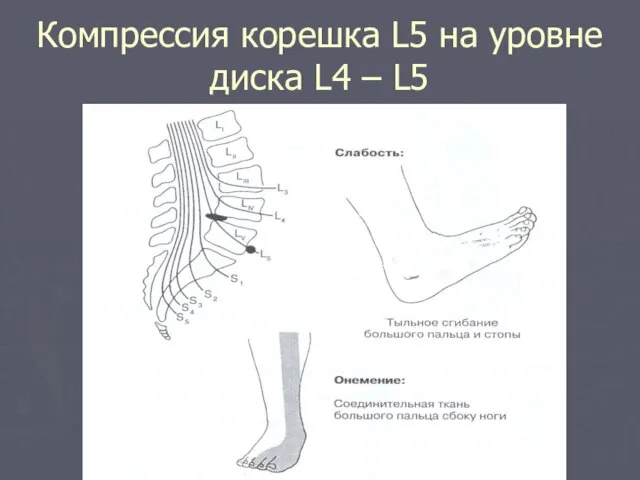 Компрессия корешка L5 на уровне диска L4 – L5