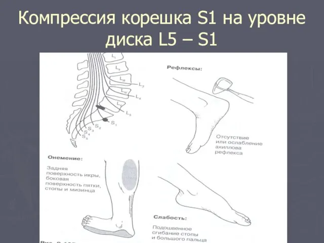 Компрессия корешка S1 на уровне диска L5 – S1