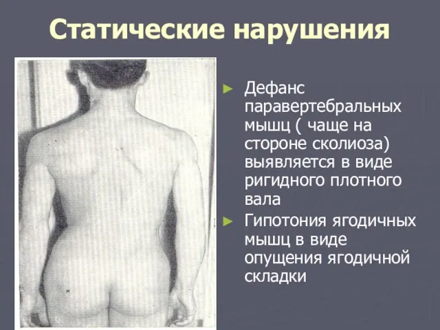 Статические нарушения Дефанс паравертебральных мышц ( чаще на стороне сколиоза) выявляется