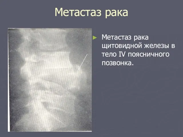 Метастаз рака Метастаз рака щитовидной железы в тело IV поясничного позвонка.