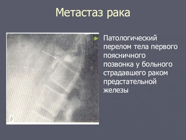 Метастаз рака Патологический перелом тела первого поясничного позвонка у больного страдавшего раком предстательной железы