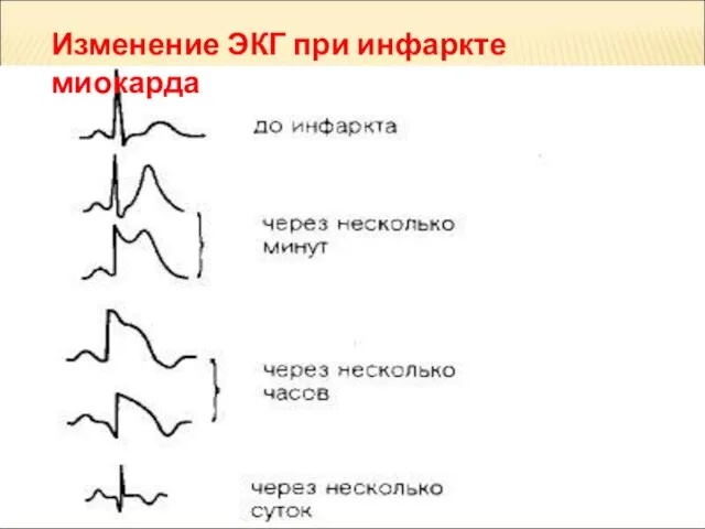 Изменение ЭКГ при инфаркте миокарда