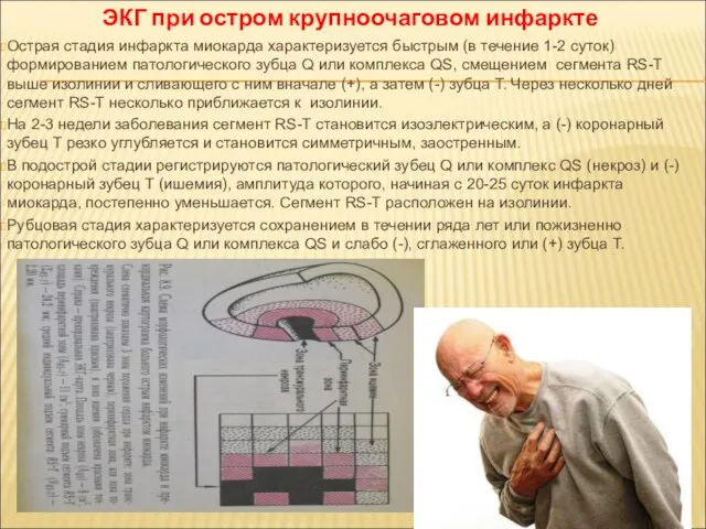 Острая стадия инфаркта миокарда характеризуется быстрым (в течение 1-2 суток) формированием