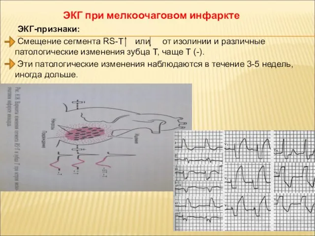 ЭКГ-признаки: Смещение сегмента RS-T или от изолинии и различные патологические изменения