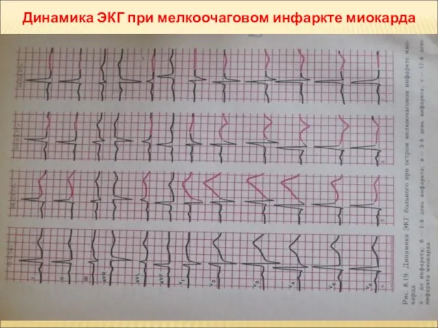 Динамика ЭКГ при мелкоочаговом инфаркте миокарда