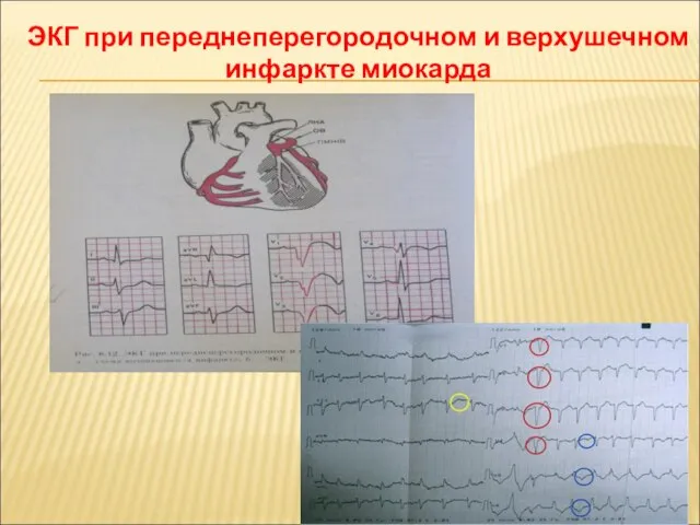 ЭКГ при переднеперегородочном и верхушечном инфаркте миокарда