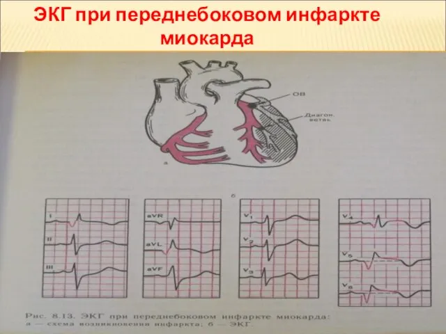 ЭКГ при переднебоковом инфаркте миокарда